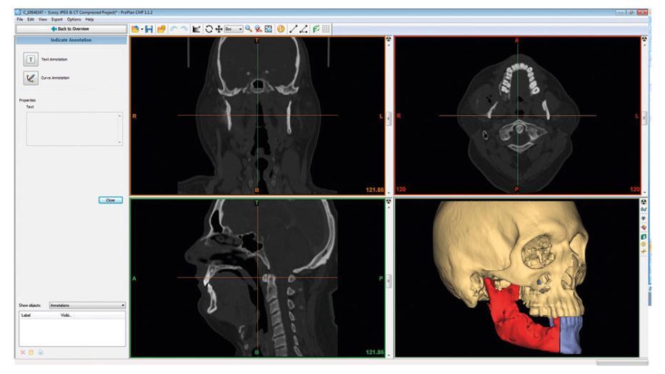 PROPLAN CMFTM  Software user interface showing osteotomy planning