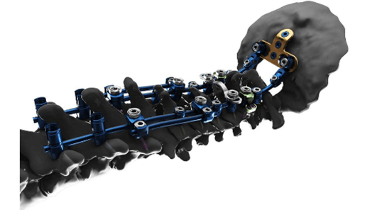 SYMPHONY™ Occipito-Cervico-Thoracic (OCT) System