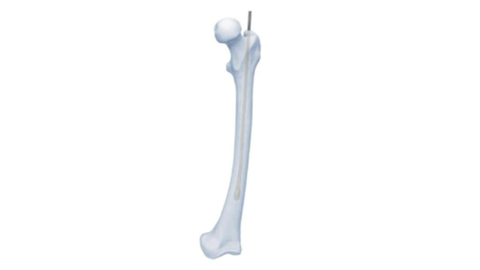 Flexible reamer used for intramedullary nails shown in bone