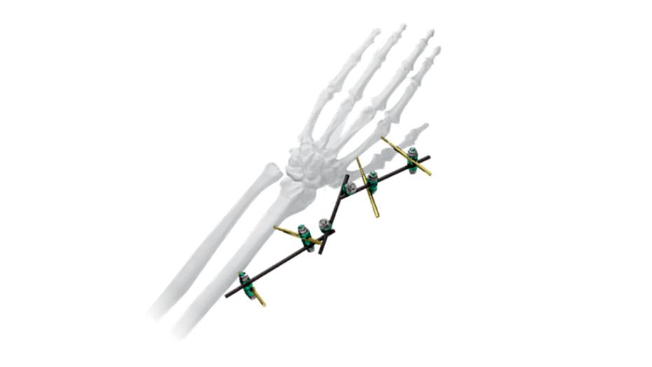 The Small External Fixation System
