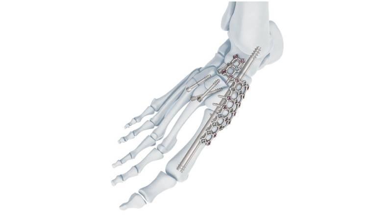 Midfoot fusion bolt inside of foot
