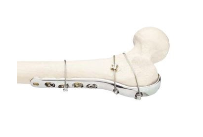 The Orthopaedic Cable System shown in place on human bone