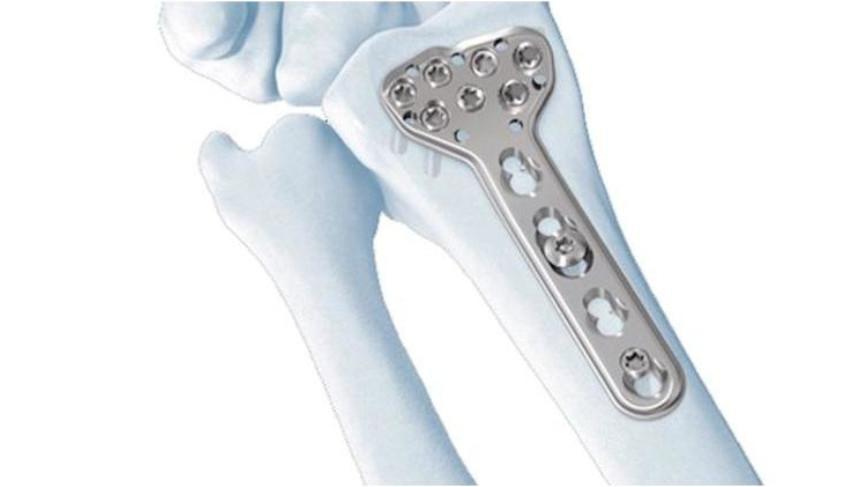 LCP Distal Radius Plate attached to bone