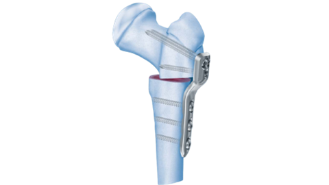 Pediatric LCP Plate System Hip Plate shown in bone in Varus Osteotomy