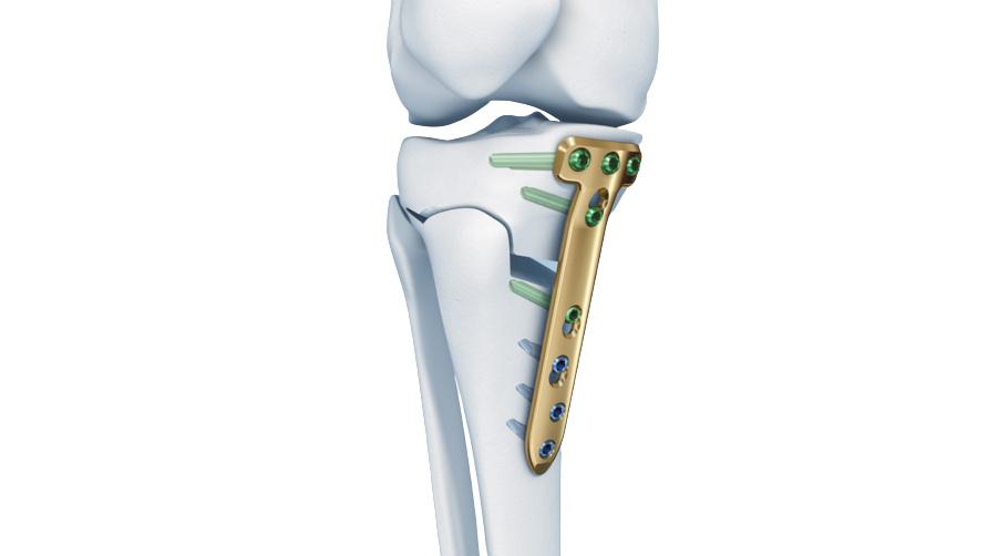 TOMOFIX™ Osteotomy System plate attached to bones of the knee