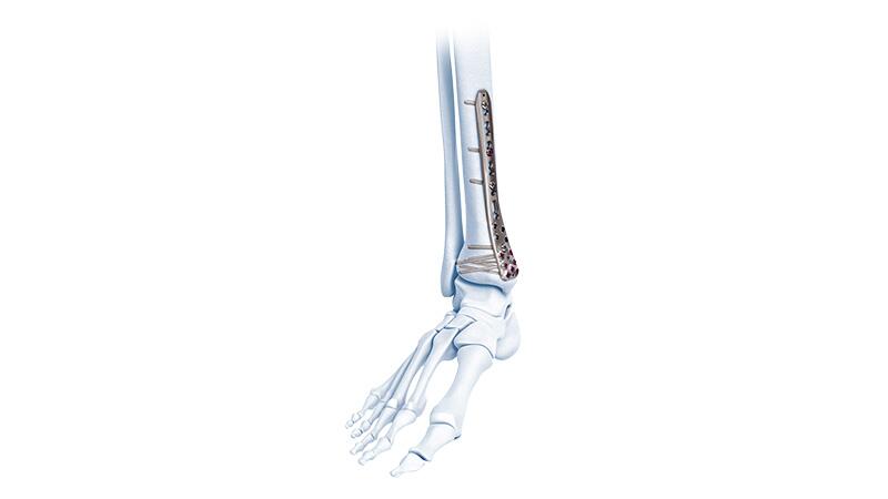 Variable Angle LCP Ankle Trauma System shown with Anteromedial Distal Tibia Plate in ankle bone.