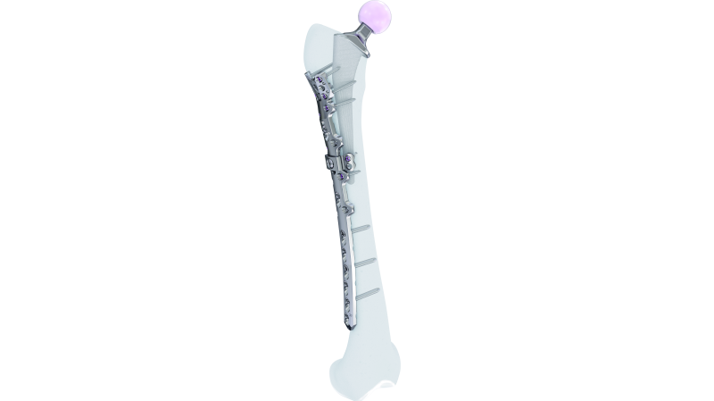 Periprosthetic Proximal Femur plate fixed on a bone