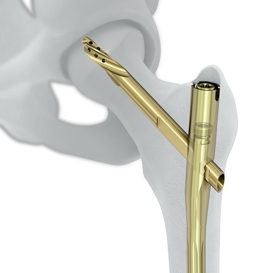 TFN-ADVANCED™ Proximal Femoral Nailing System (TFNA)