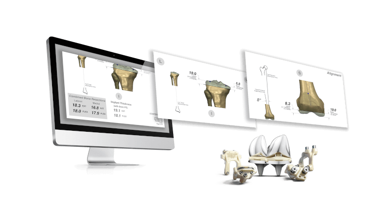 Screens showing personalized knee plan and also knee implants and resection guides