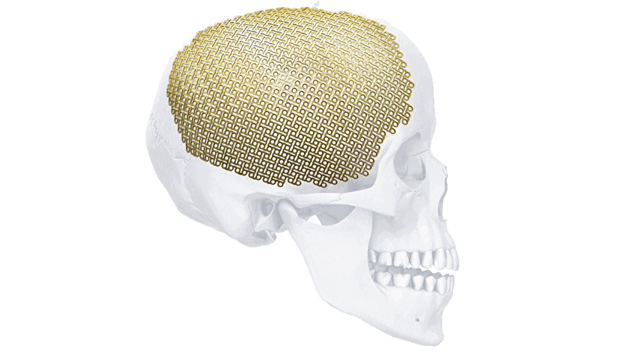 MatrixNEURO Preformed Mesh shown on human skull