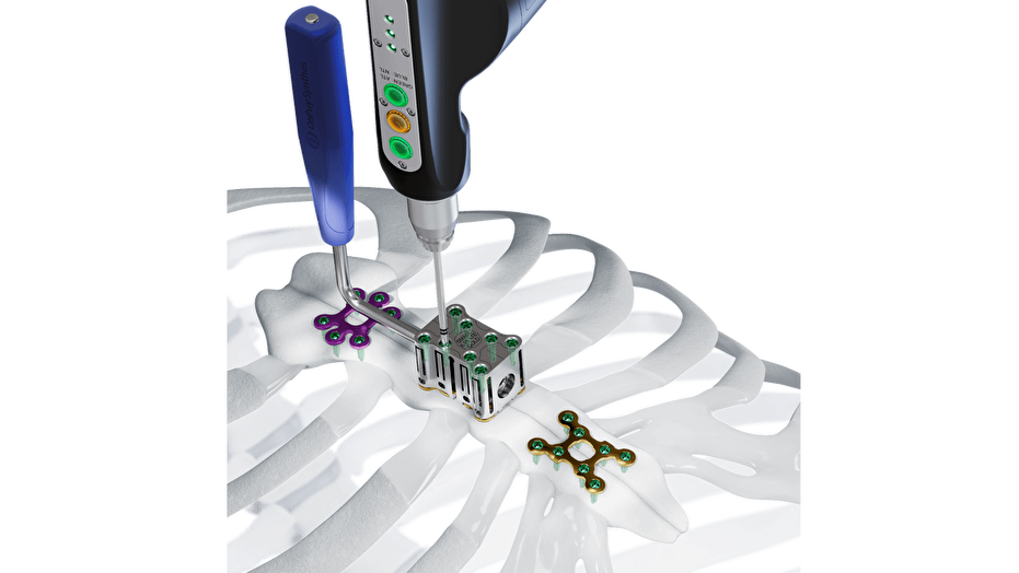 The MatrixSTERNUM Fixation System shown being affixed to bones of sternum 