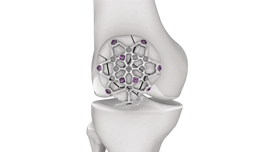 Variable Angle Locking Patella Plating System