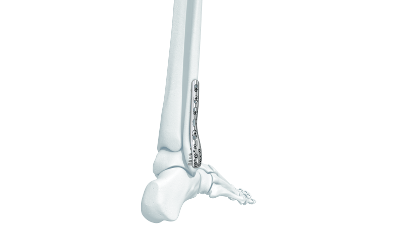 LCP Distal Fibula Plate attached to bone