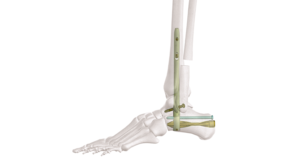 The Hindfoot Arthrodesis Nail shown in foot bone side view