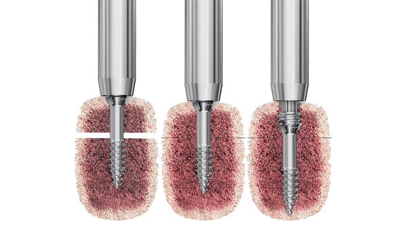 Headless compression screws inserted into bone