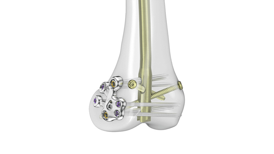 RFN-ADVANCED System with locking plate seen affixed inside bone 