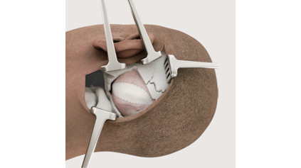 SYNTHECEL Dura Repair Retrosigmoid Craniotomy
