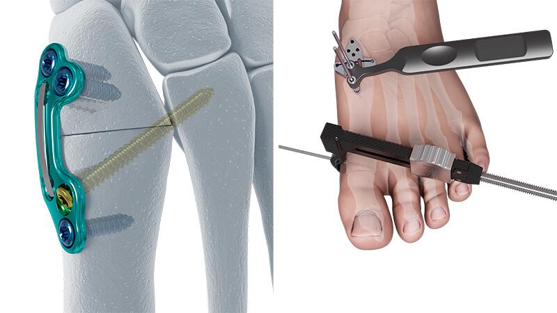 DYNABUNION System including implants and instruments for Bunion treatment.