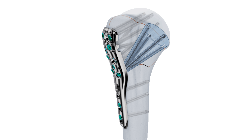 VOLT Proximal Humerus Plate on bone