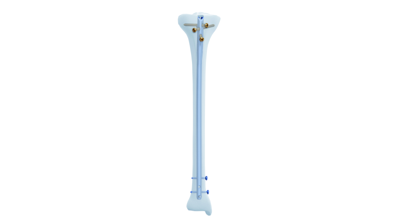 Periprosthetic Proximal Femur plate fixed on a bone