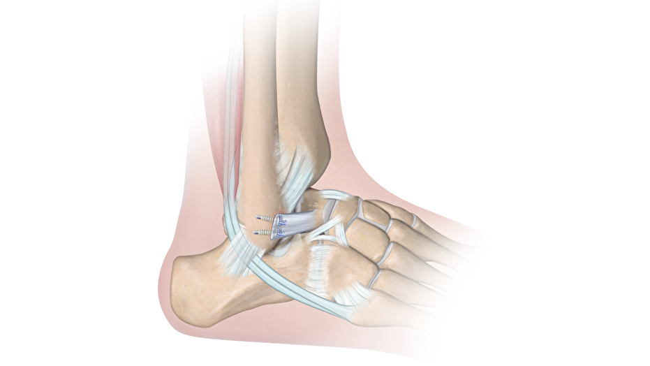 GRYPHON X Anchors inserted in fibula for ATFL repair 