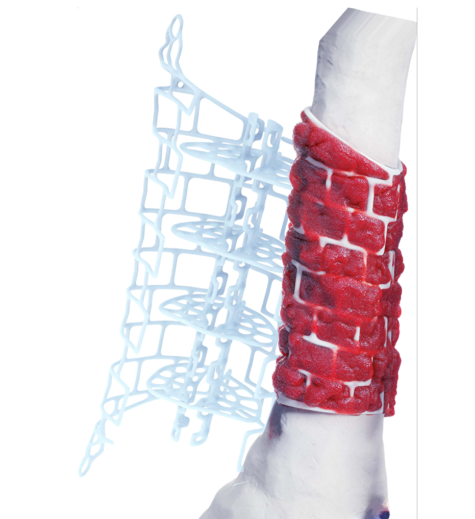 Graft Cage in Tibia  