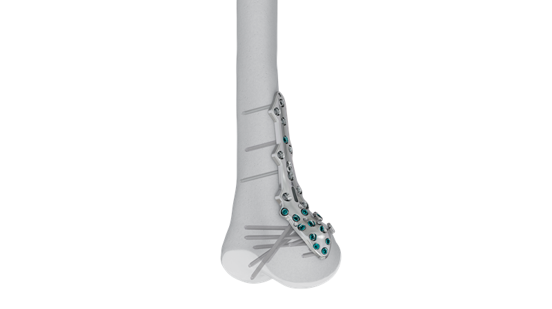 VOLT Medial Distal Femur Plate
