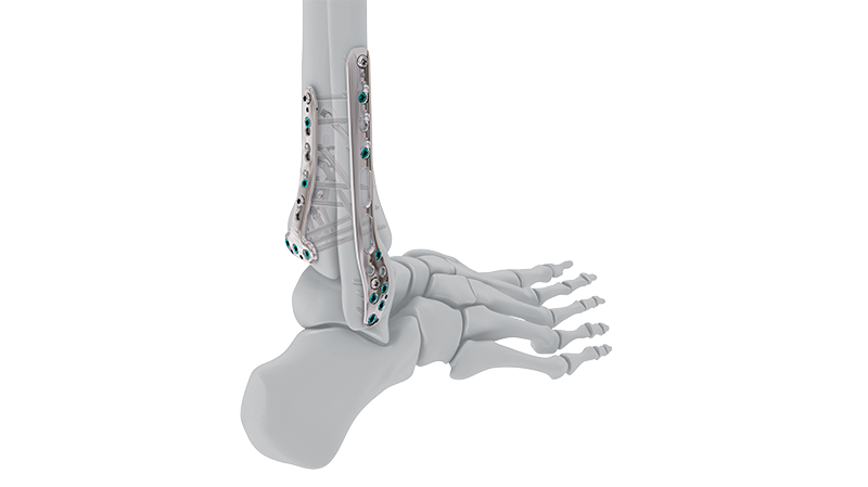 VOLT Ankle Plate