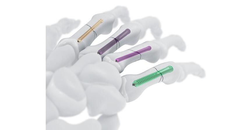 Intramedullary Implant System 1