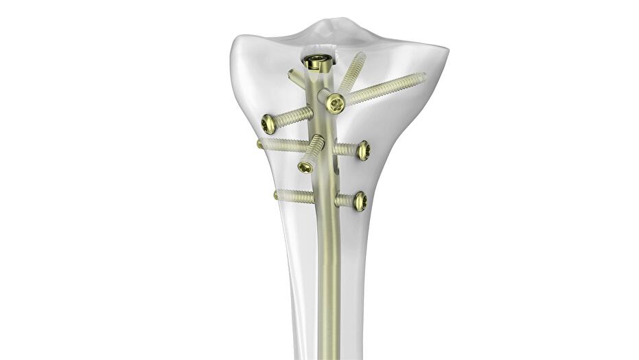 TN advanced tibial