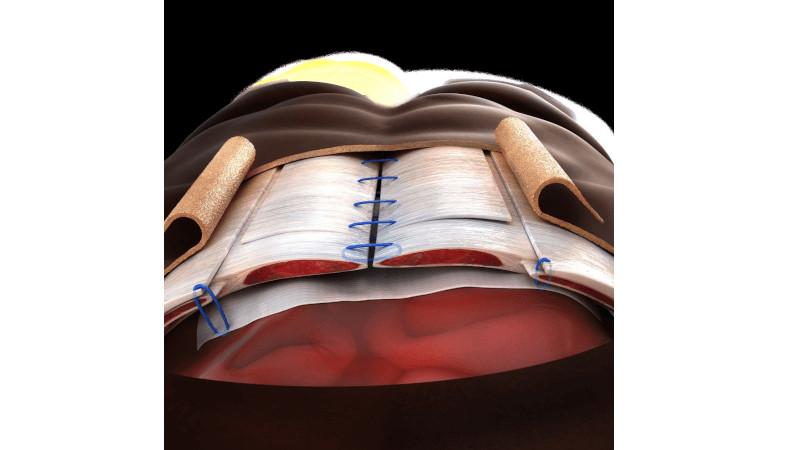 XCM Biologic™ Tissue Matrix